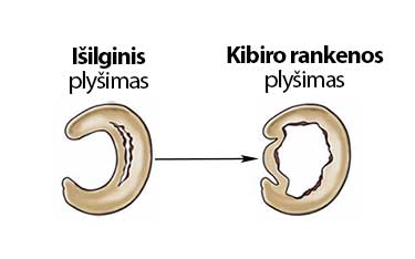 Išilginis ar kibiro rankenos meniskų plyšimai